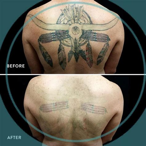 removery tattoo removal & fading